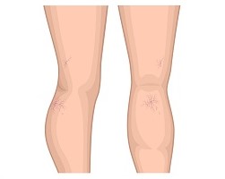 Spider Veins Spider Veins