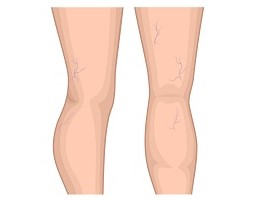 Reticular Veins Reticular Veins