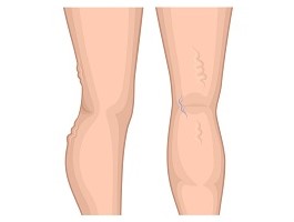 Varicose Veins Varicose Veins